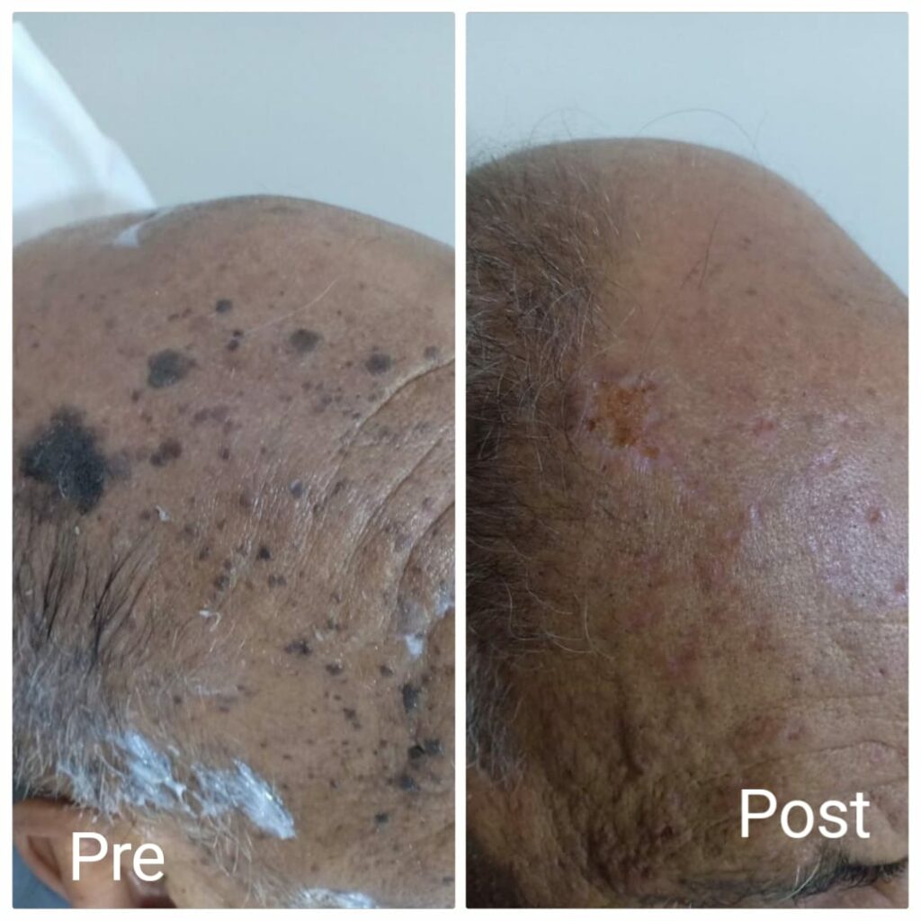 Get rid of skin tags in the head